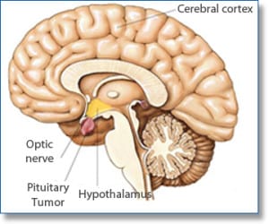 pituitary_gland_illust_tumor